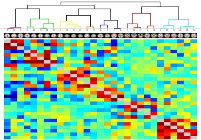 Submaximal Exercise Provokes Increased Activation of the Anterior Default Mode Network During the Resting State as a Biomarker of Postexertional Malaise in Myalgic Encephalomyelitis/Chronic Fatigue Syndrome